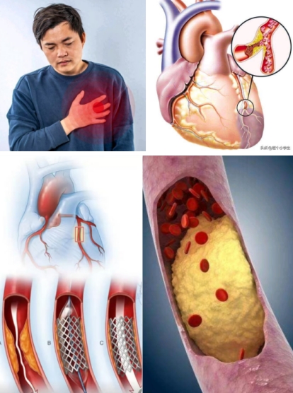冠心病到底 能不能彻底痊愈?养生素发明成功挑战不可能! 冠心病到底 能不能彻底痊愈?养生素发明成功挑战不可能!