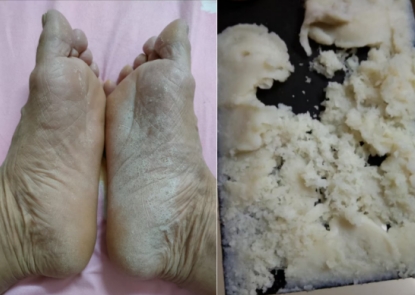 冠心病到底 能不能彻底痊愈?养生素发明成功挑战不可能! 冠心病到底 能不能彻底痊愈?养生素发明成功挑战不可能!