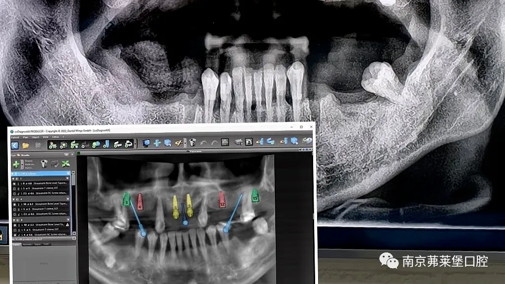 南京茀莱堡口腔/数字化可视导航种植简介，让种牙看得见，诊疗更精准
