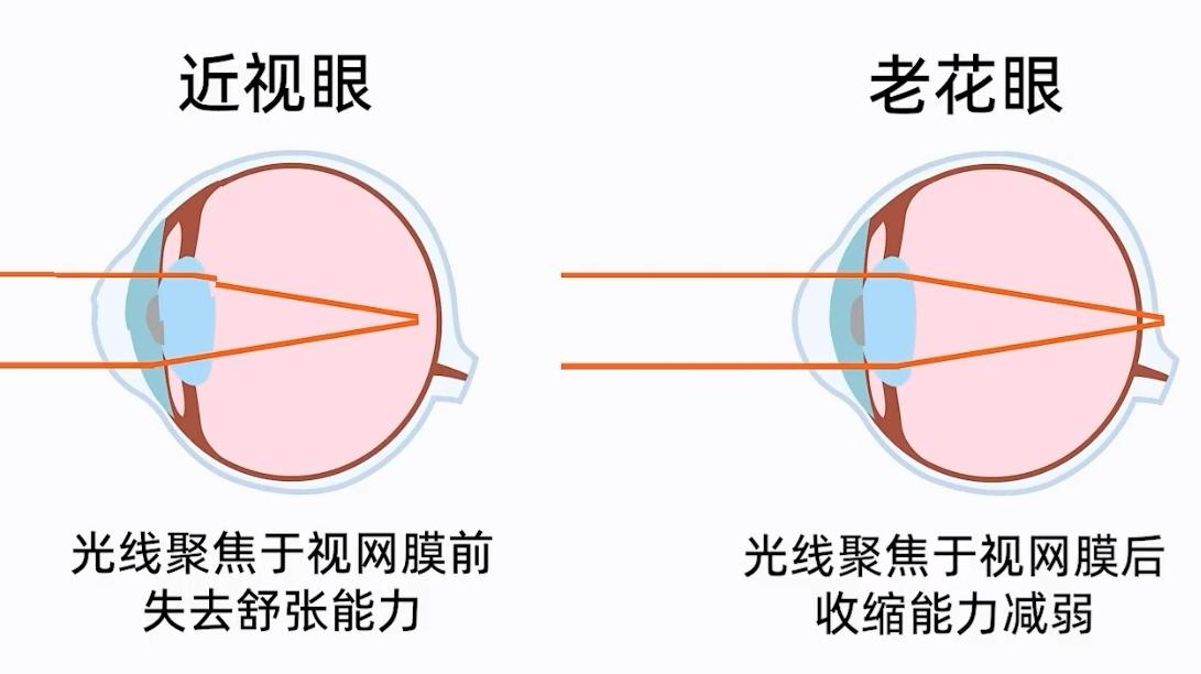 蔡司智锐渐进镜片：守护近视与老花的双重挑战