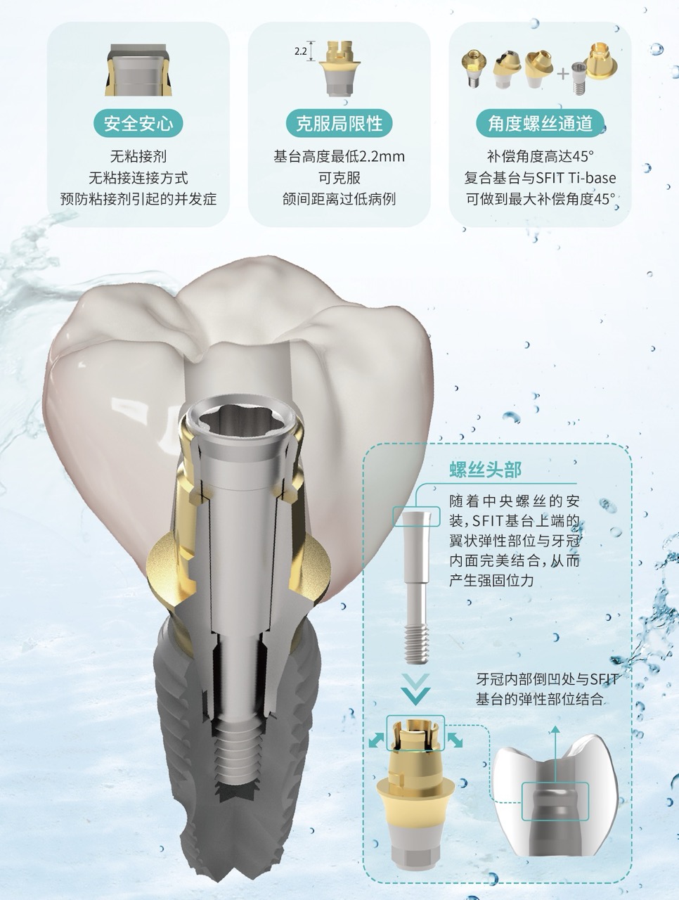 柯威尔SFIT无粘接修复系统产品力强大，全球市场发展趋势向好