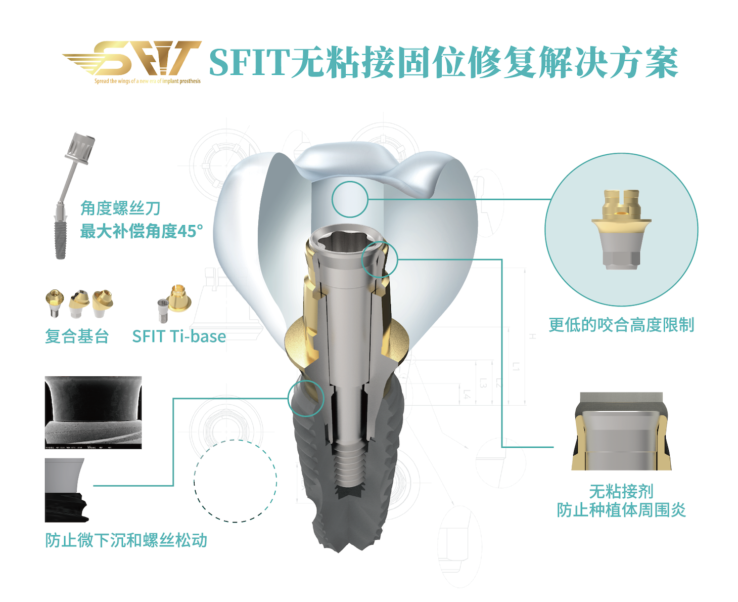 柯威尔SFIT无粘接修复系统产品力强大，全球市场发展趋势向好