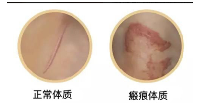 威兹曼解密病理性瘢痕：科学诊疗重塑自信肌肤