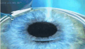 郑州半飞秒手术的优势？尖峰眼科