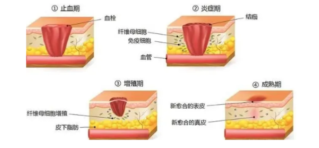 增生性疤痕不再怕，新疆威兹曼有妙法