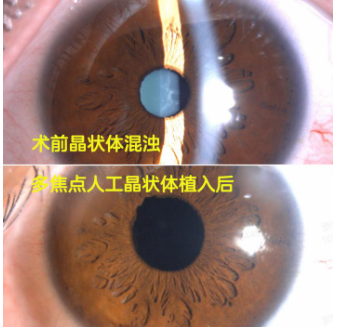 生娃竟也伤眼？女子2次产后视力骤降，福州爱尔眼科医生：激素紊乱引起