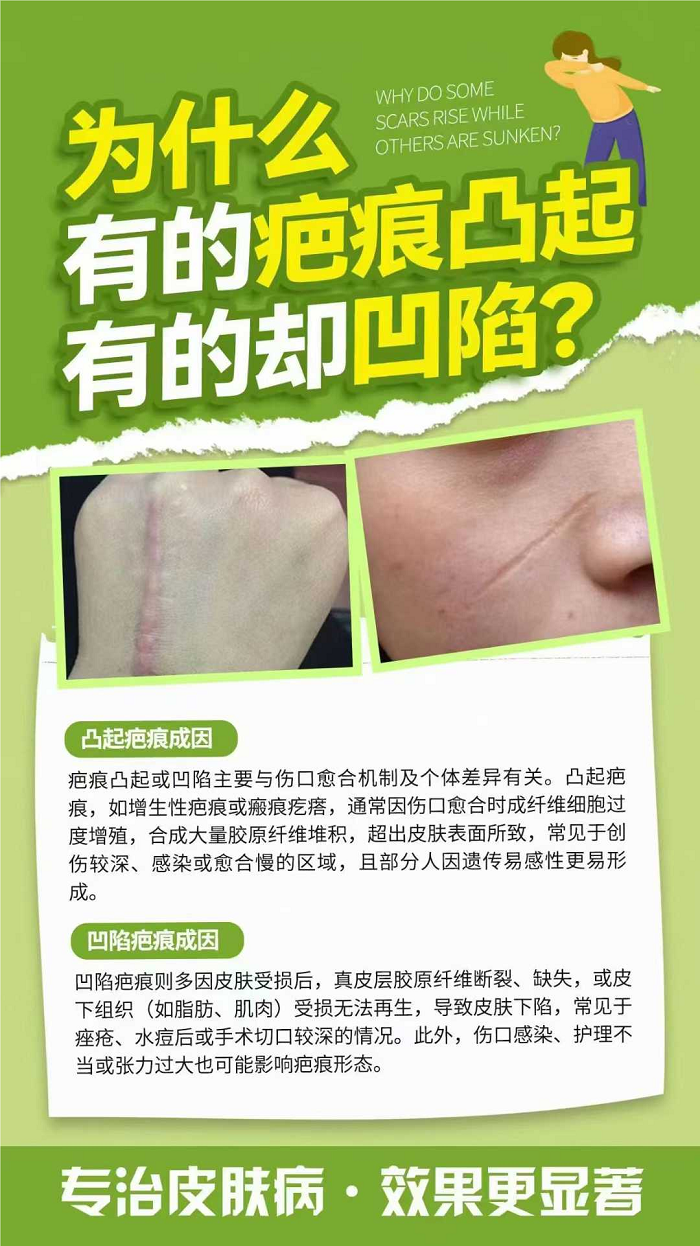 为自己而美！新疆威兹曼帮乌市瘢痕患者重拾自信