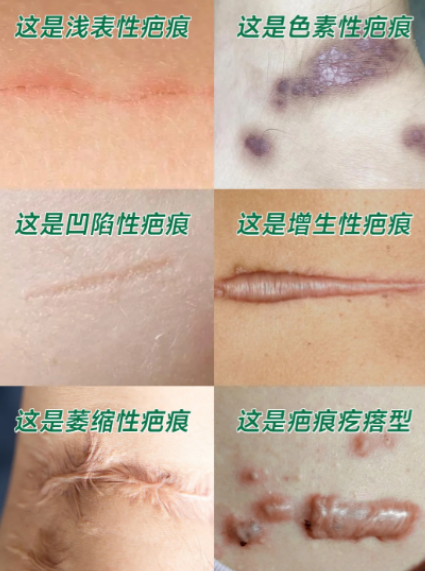 高峰医生:环钻微创点状植皮术,让瘢痕修复更自然