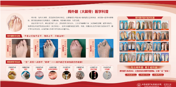 哪些情况下拇外翻需要治疗，北京国康拇外翻田启超主任带您了解