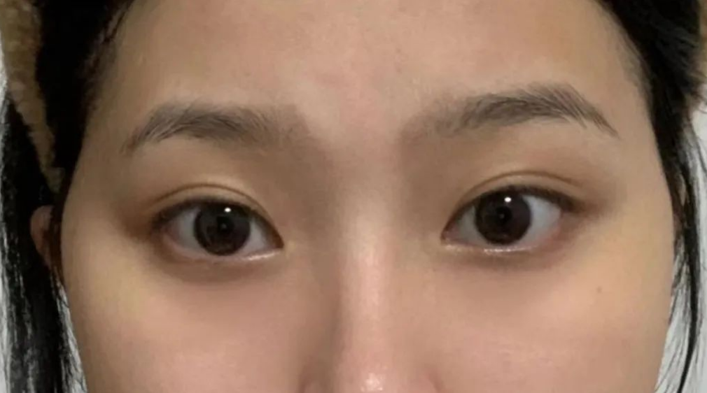 太阳穴凹陷的菱形脸爆改减龄“头包脸”指南，杏林医美