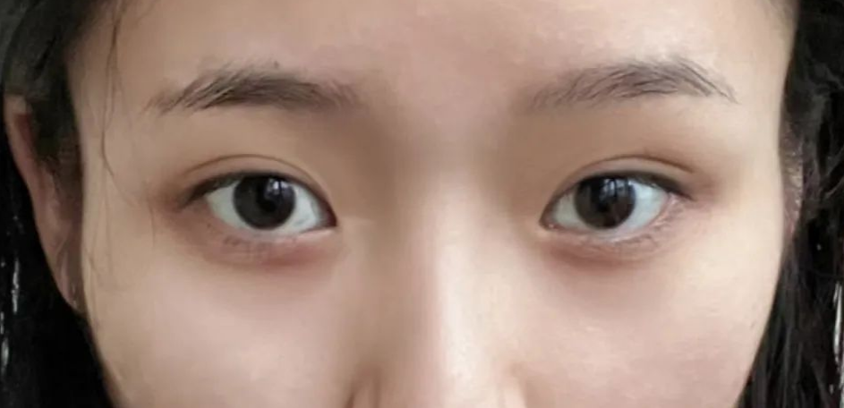 太阳穴凹陷的菱形脸爆改减龄“头包脸”指南，杏林医美