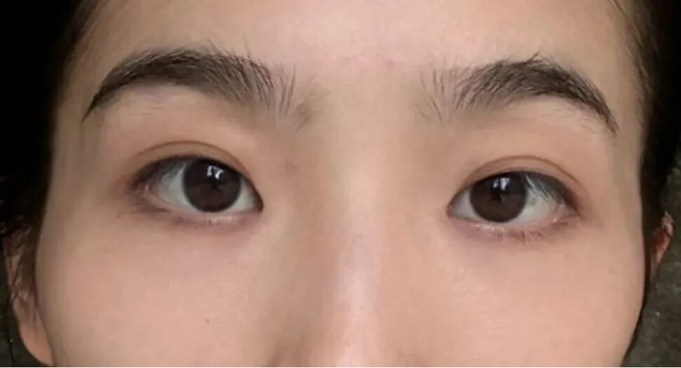 太阳穴凹陷的菱形脸爆改减龄“头包脸”指南，杏林医美