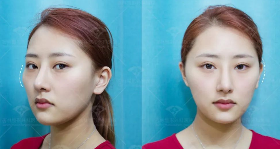 太阳穴凹陷的菱形脸爆改减龄“头包脸”指南，杏林医美