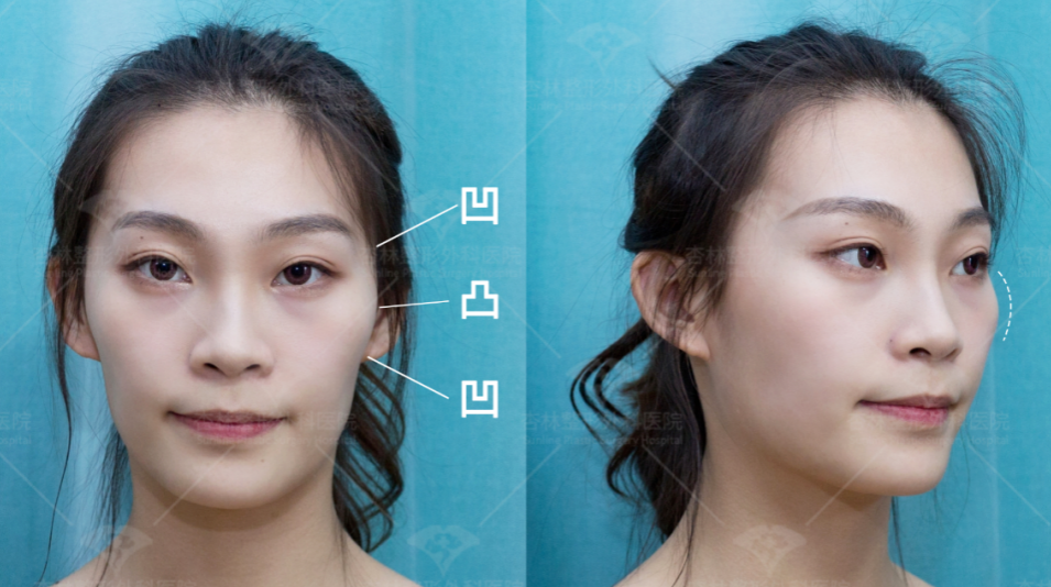 太阳穴凹陷的菱形脸爆改减龄“头包脸”指南，杏林医美