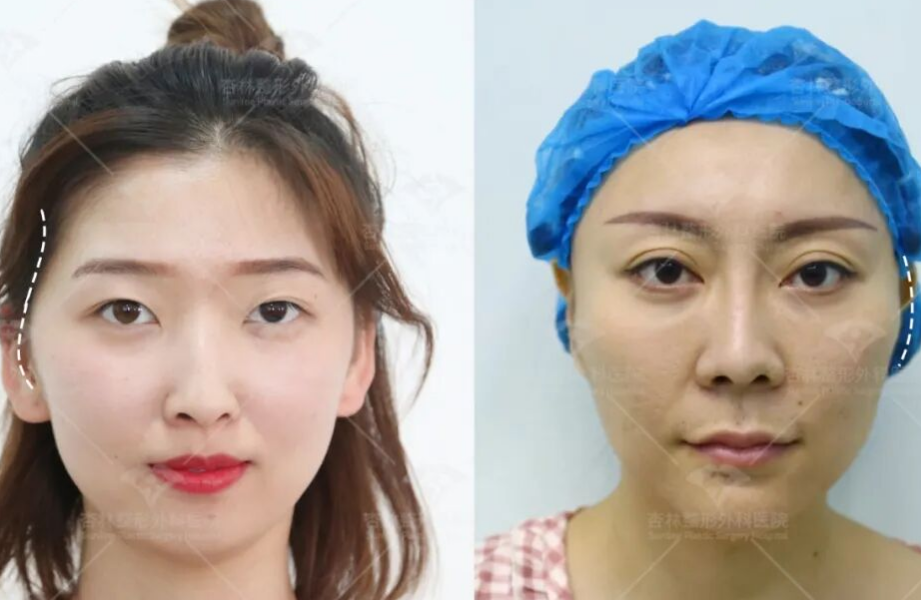 太阳穴凹陷的菱形脸爆改减龄“头包脸”指南，杏林医美