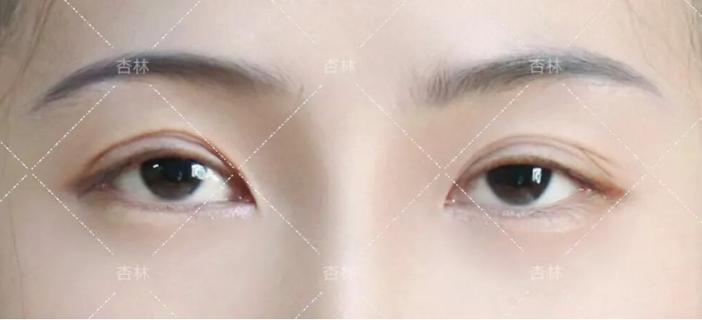 不是越大越好看？原来80%的人都做错，杏林眼综合