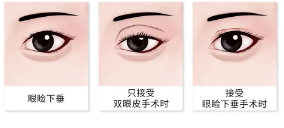 不是越大越好看？原来80%的人都做错，杏林眼综合