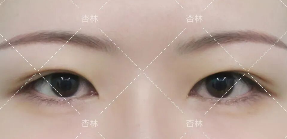 不是越大越好看？原来80%的人都做错，杏林眼综合