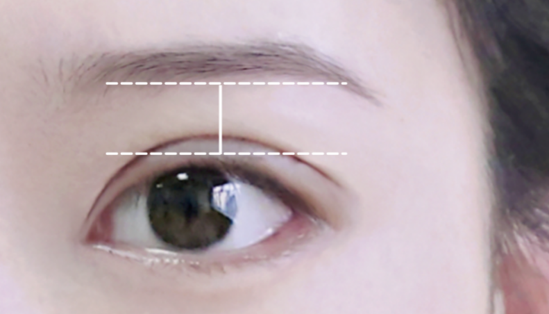 不是越大越好看？原来80%的人都做错，杏林眼综合