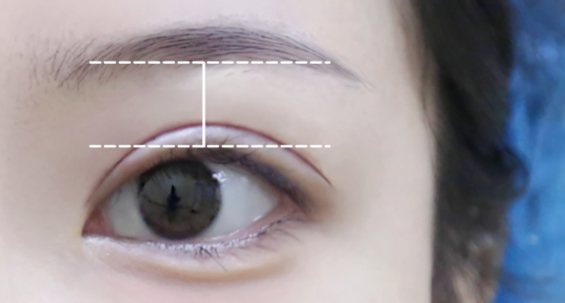 不是越大越好看？原来80%的人都做错，杏林眼综合