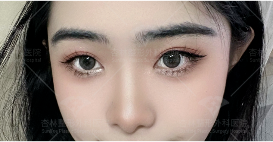 不是越大越好看？原来80%的人都做错，杏林眼综合