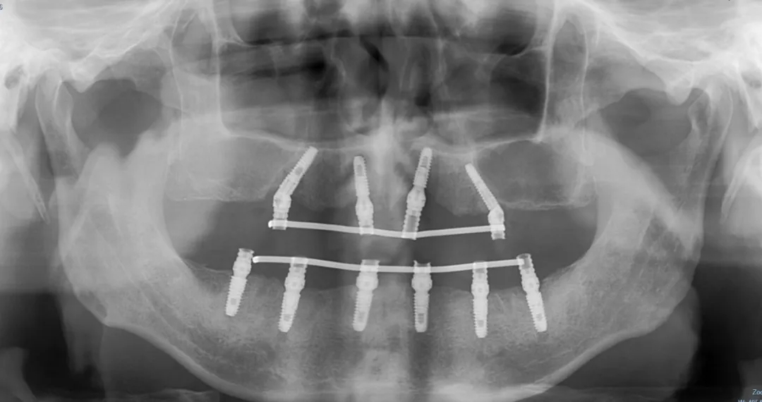 “不想拔最后一颗牙！”海南老人来沪实现半口牙“重生”