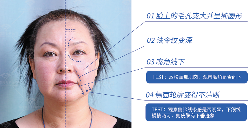 部分都只做了“表面功夫”,那些衰老的慢的人怎么做的,杏林第五代除皱术 部分都只做了“表面功夫”,那些衰老的慢的人怎么做的,杏林第五代除皱术