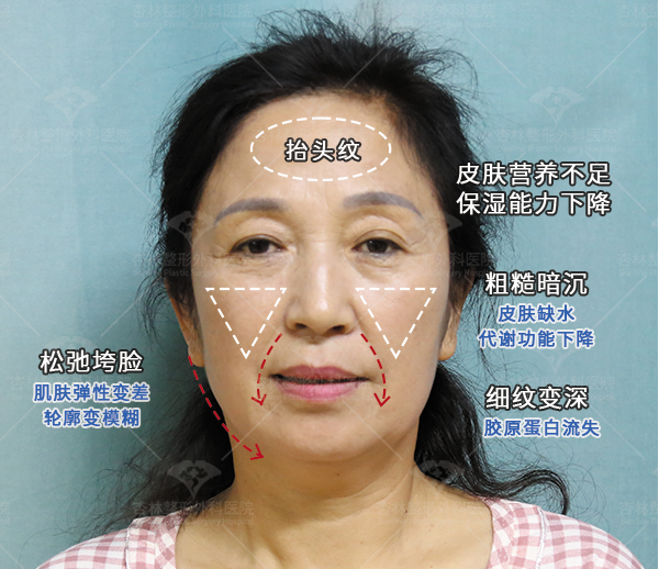 部分都只做了“表面功夫”,那些衰老的慢的人怎么做的,杏林第五代除皱术 部分都只做了“表面功夫”,那些衰老的慢的人怎么做的,杏林第五代除皱术