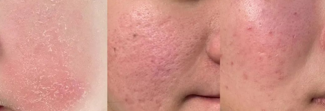 部分都只做了“表面功夫”,那些衰老的慢的人怎么做的,杏林第五代除皱术 部分都只做了“表面功夫”,那些衰老的慢的人怎么做的,杏林第五代除皱术