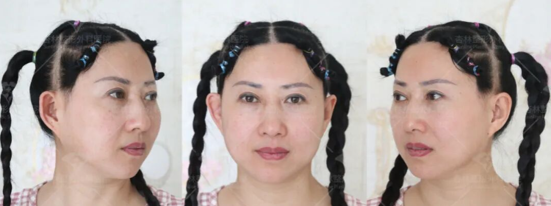 部分都只做了“表面功夫”,那些衰老的慢的人怎么做的,杏林第五代除皱术 部分都只做了“表面功夫”,那些衰老的慢的人怎么做的,杏林第五代除皱术