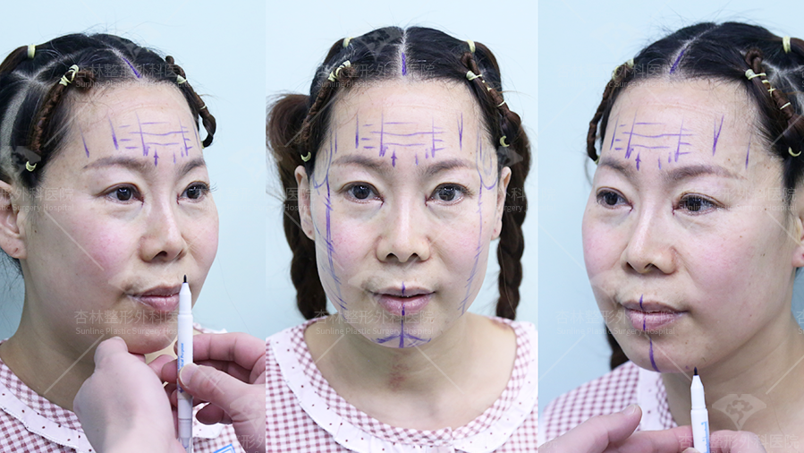 部分都只做了“表面功夫”,那些衰老的慢的人怎么做的,杏林第五代除皱术 部分都只做了“表面功夫”,那些衰老的慢的人怎么做的,杏林第五代除皱术