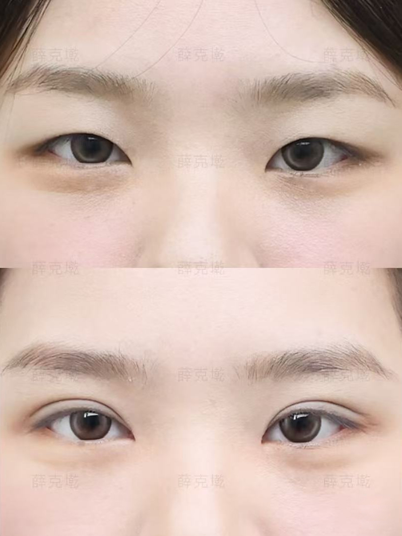 “显微精细”叠加“动态美学”：福州专家薛克墘的双眼皮为何备受推崇