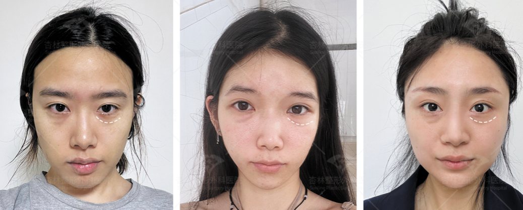 为什么祛完眼袋老了10岁？杏林祛眼袋