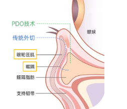 为什么祛完眼袋老了10岁？杏林祛眼袋