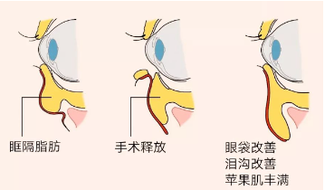 为什么祛完眼袋老了10岁？杏林祛眼袋