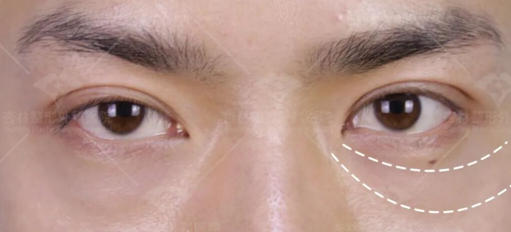 为什么祛完眼袋老了10岁？杏林祛眼袋