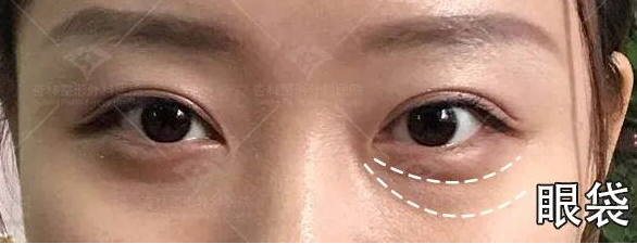 为什么祛完眼袋老了10岁？杏林祛眼袋