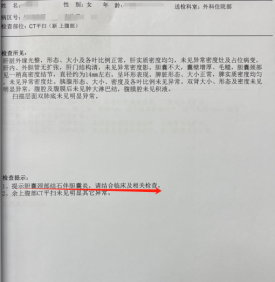 【重庆】32岁女子胆囊藏13颗结石 余建明主任经脐隐痕保胆取石成功