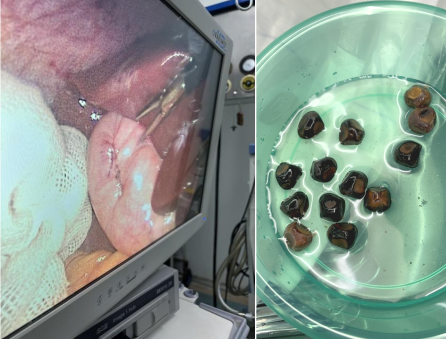 【重庆】32岁女子胆囊藏13颗结石 余建明主任经脐隐痕保胆取石成功